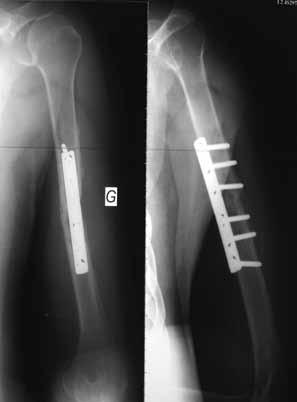 Although plate fixation remains one of the most efficient techniques, poor bone quality or a deficient plating technique may lead to failure to heal the non-union (2,16).
