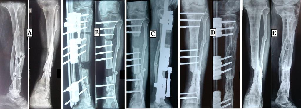 48 Strat Traum Limb Recon (2017) 12:45 51 Fig. 3 a. 35-year-old male with infected non-union of Tibia of 11-year duration following compound fracture of both bone leg.