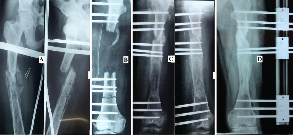 4 a 19-year-old male with infected non-union of femur following pathological fracture due to chronic osteomyelitis. b Debridement and rail fixation application. c Callus formation.