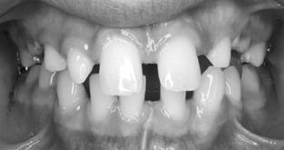 II, division 1 malocclusion with spacing due