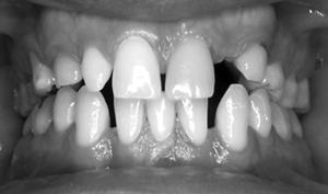 patient with multiple congenitally missing teeth.