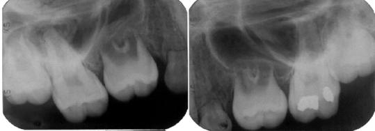 second molar into the upper left premolar site (March, 1987).