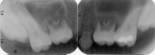 lower right second molar into the upper right premolar region