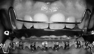 second premolar sites and the use of