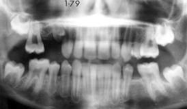 Mock tooth for trial insertion