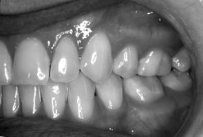 Left: Periapical view taken 4 months after