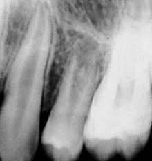 dura, periodontal space and continued growth of
