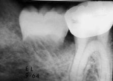 Northway Case 2. Left: Impacted second molar (Aug.