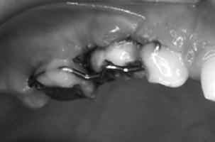Right: Hammock soldered to a band on an adjacent tooth.