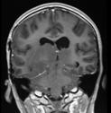 Based on imaging findings (tumor arising in thalamus) - Diffuse glioma - Gliomatosis cerebri - Other astrocytic tumor