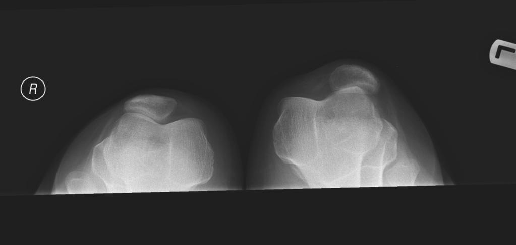 Patellofemoral Instability: Diagnosis and Management http://dx.doi.org/10.5772/56508 95 (including avulsion fractures), and osteochondral fragments.