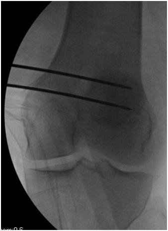 Patellofemoral Instability: Diagnosis and Management http://dx.doi.org/10.5772/56508 103 of the patella is exposed first and burred down to bleeding bone, to encourage healing.