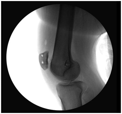 the patella; d) intraoperative lateral image showing a radiographic template overlying the distal femur, allowing placement of the guidewire in the appropriate position for a femoral tunnel; e)