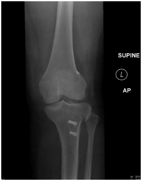 Patellofemoral Instability: Diagnosis and Management http://dx.doi.org/10.5772/56508 107 Hughston osteotomy transfers the tibial tubercle distally and medially.