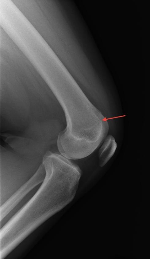 94 Current Issues in Sports and Exercise Medicine include plain radiographs, magnetic resonance imaging (MRI), and ultrasound (US). The computed tomography (CT) scan is used less commonly.