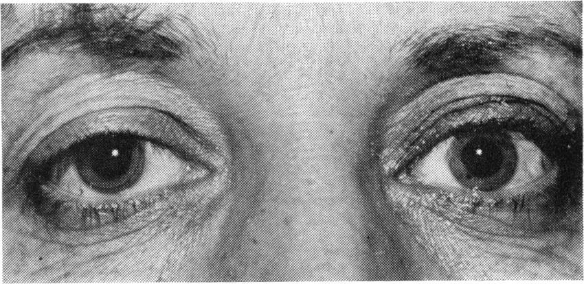 588 - -9-C? - -.-.- Fig. 6 Eyelid structures reapposed after tying sutures over bolsters Fig.