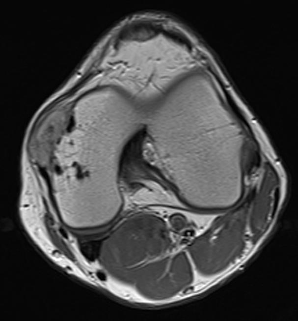 The intermediate-to-low signal intensity portion was seen in the tumor. The posterior portion of the mass was adherent to the femoral origin of the medial collateral ligament.