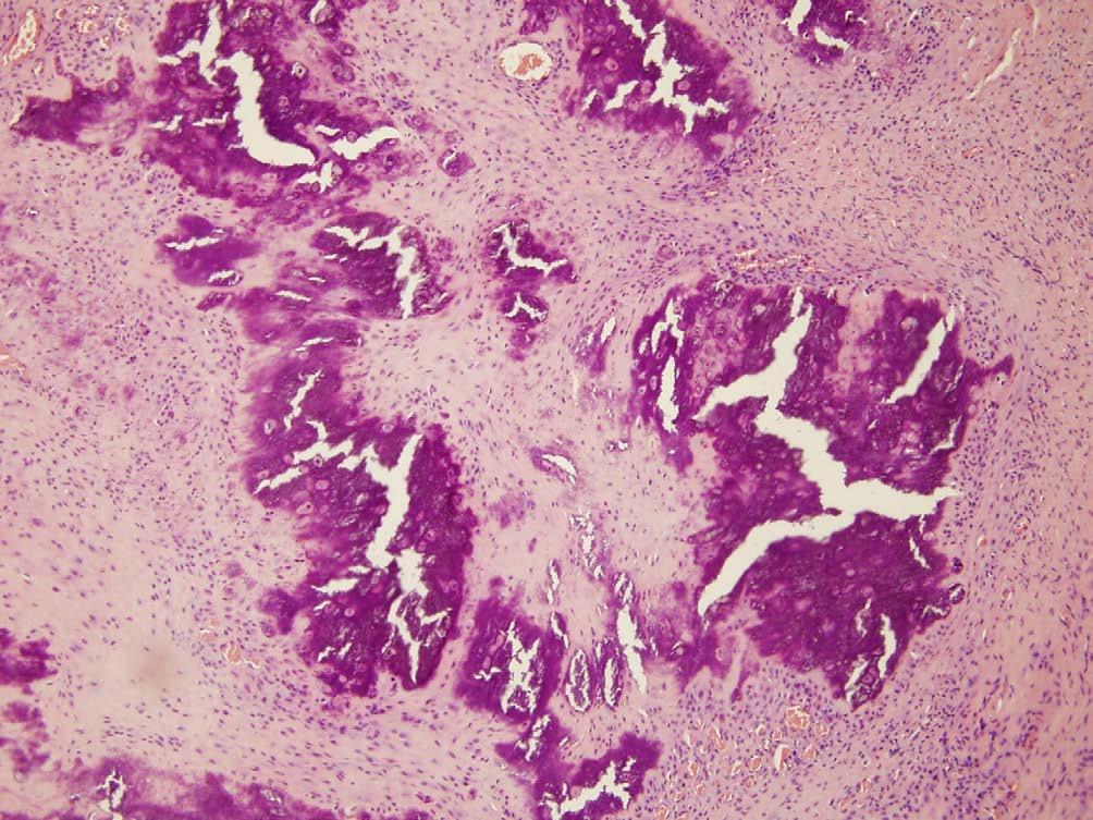(c) Cartilaginous differentiation and hyalinization in calcified areas are well seen on another slide ( 100; H&E staining).