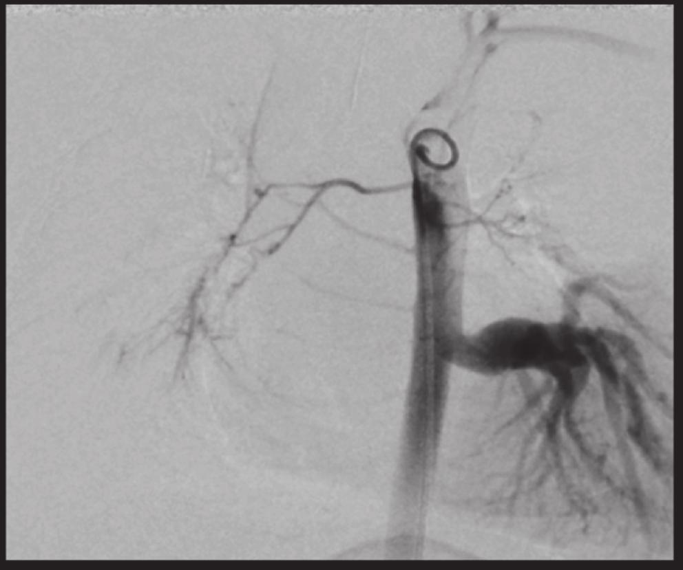 2 Case Reports in Cardiology Figure 1: Aortic cineangiogram.