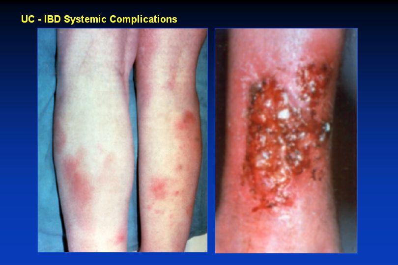 Erythema Nodosum More common in Crohn s (up to 15%), less in UC (up to 5%) Young women at most risk Painful tender