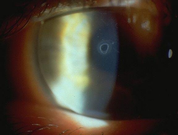Case 2 Corneal Erosions Case 2 Corneal Erosions (continued) Rx: punctal cautery, bilateral Still nocturnal awakening with burning eyes vaporizer, ointment, tetracaine Repeat