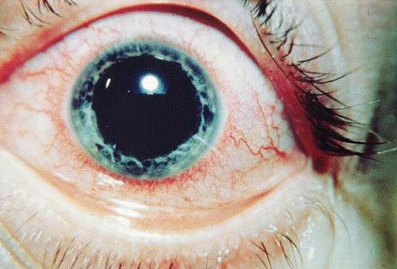 Ocular Complications: Uveitis Inflammation of anterior chamber Prevalence 5% Ocular pain, redness, photophobia Slit lamp exam necessary for diagnosis Acute form associated with