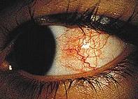 Other Ocular Complications Episcleritis Episcleritis Outer layers of eye Eye burning or itching, erythema Activity correlates to IBD