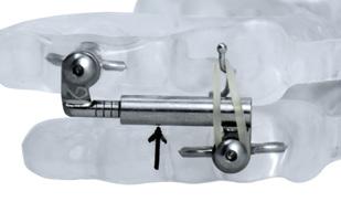 Item # 63250SLS The delivery visit should confirm the fit and comfort of the appliance, as well as the patients ability to insert and remove it properly and without difficulty.