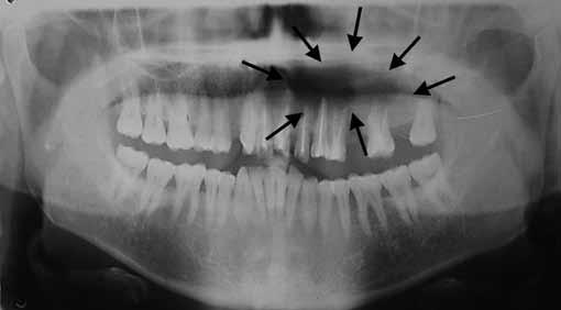 Heena Sonawane et al left central and lateral incisors was seen. Maxillary left 2nd premolar and 2nd molar were missing (Fig. 8). Discussion Fig.