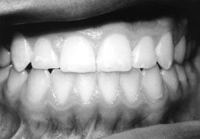 Maxillary Dentition Downward movement of the maxilla provided about 1.