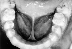 intrusive force transmitted from extrusion of the incisors.