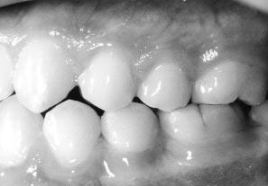 Mild root resorption was apparent in the upper incisors.