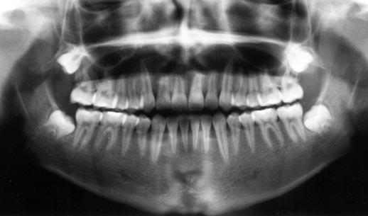 American Journal of Orthodontics and Dentofacial Orthopedics Smith and English 183 Volume 116, Number 2 Retention The patient wore his positioner for 3 weeks when final records were taken.