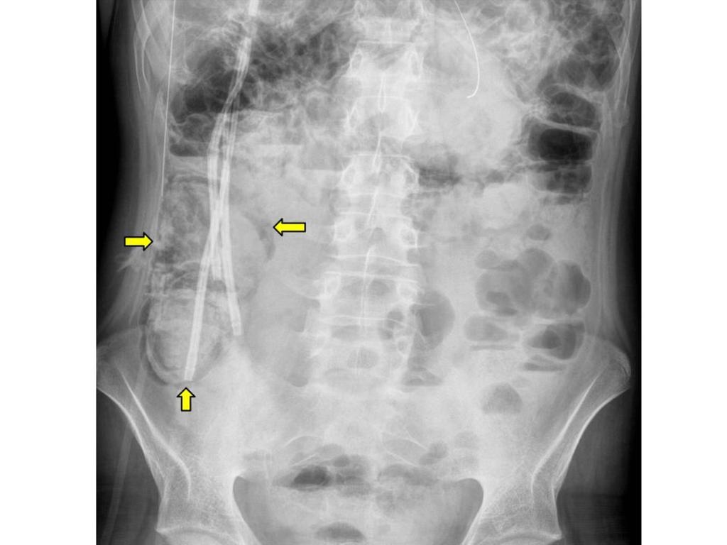 Images for this section: Fig. 3: A 20 year-old patient with diarrhea after bone marrow transplantation.