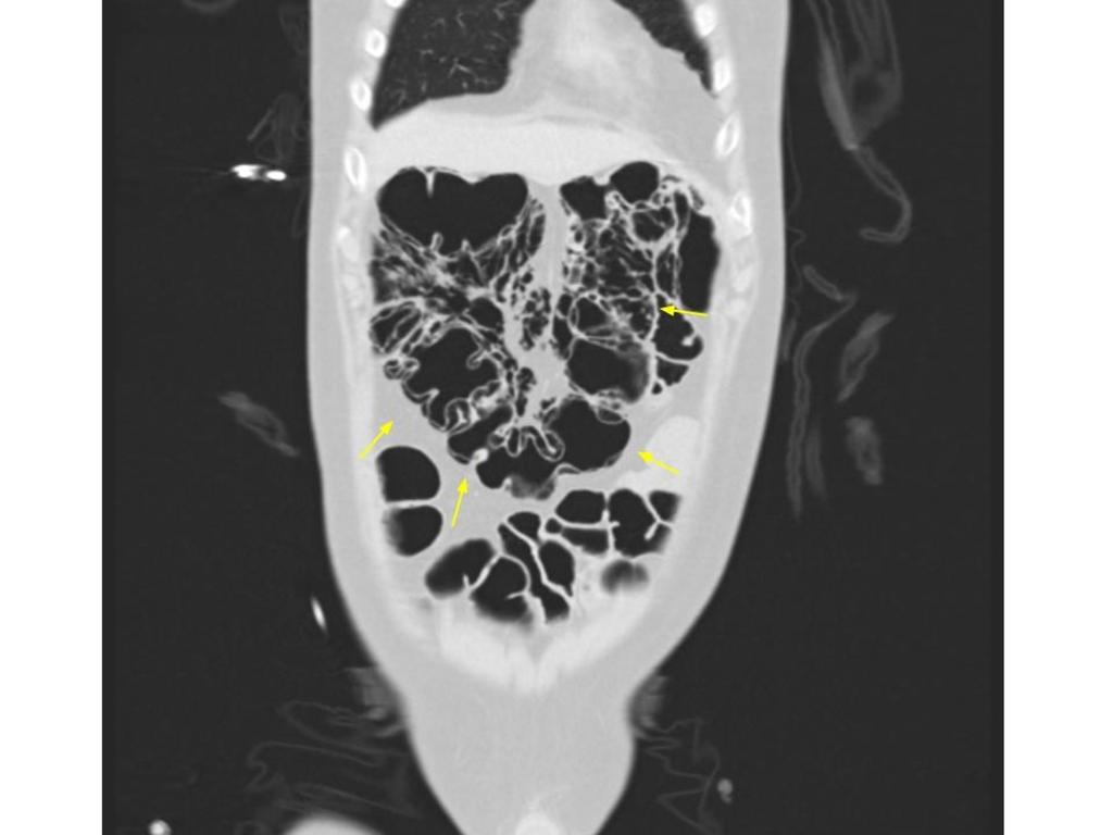 Fig. 4: A 20 year-old patient with diarrhea after bone marrow transplantation.