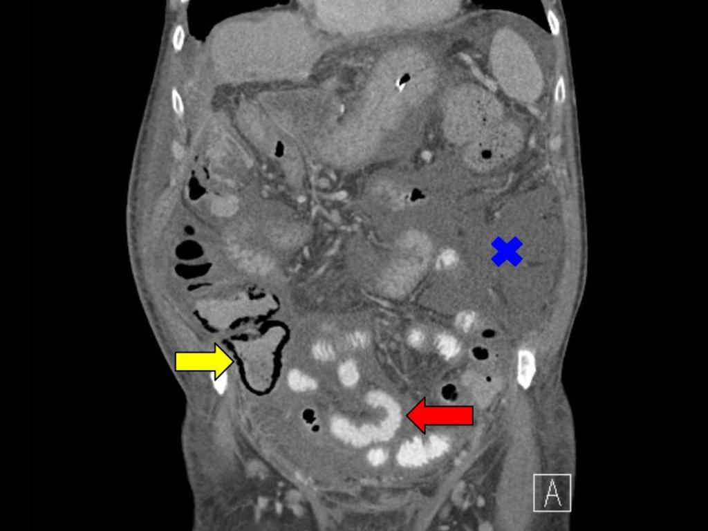 Fig. 7: Additional sign: bowel wall thickening. CT of a 69-year-old patient with portal vein thrombosis.