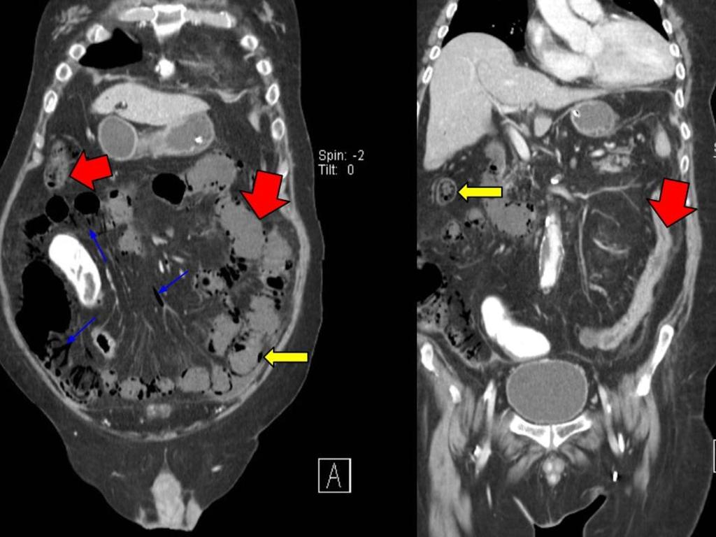 Fig. 8: Additional sign: absent mucosal enhacement. A 76-year-old man with transmural small bowel ischemia.