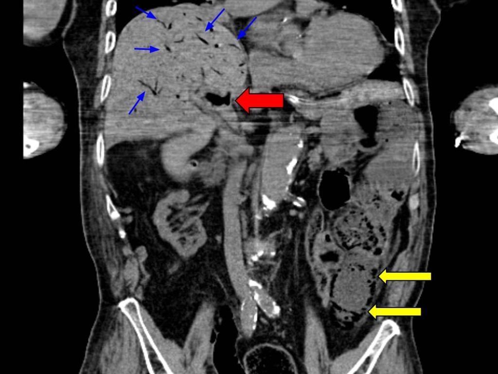 Fig. 10: Additional sign: portal gas. A 89-year-old man with closed loop small bowel obstruction complicated with strangulation.