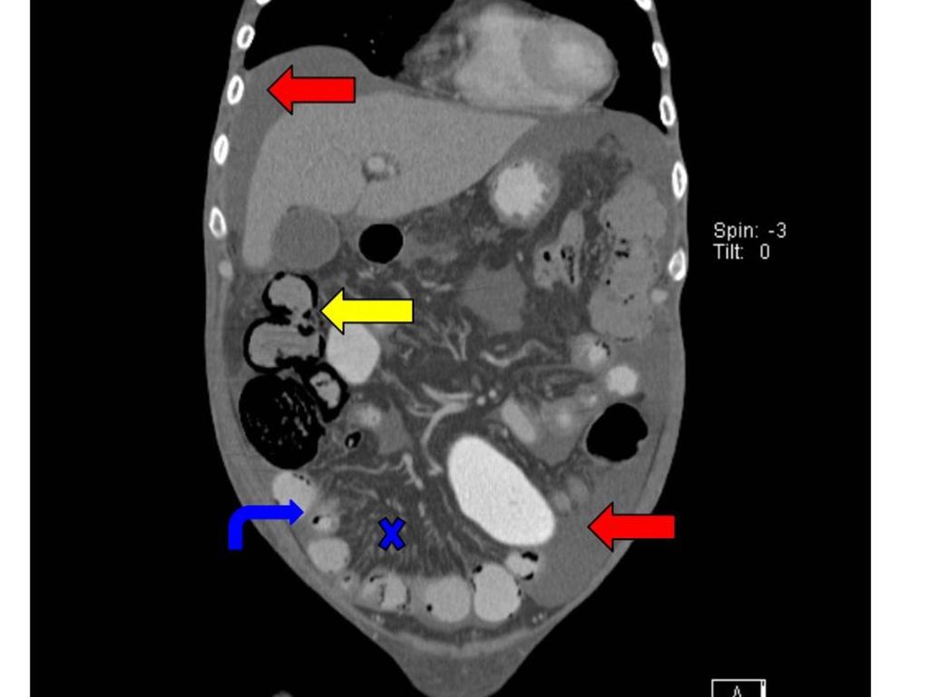Fig. 11: Additional sign: ascites. Pneumatosis intestinalis (yellow arrow) in a M. Kahler patient undergoing bone marrow transplantation.