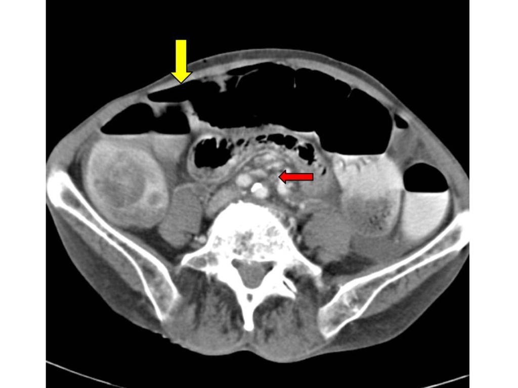 Fig. 12: Additional sign: arterial occlusion and free intraperitoneal air.