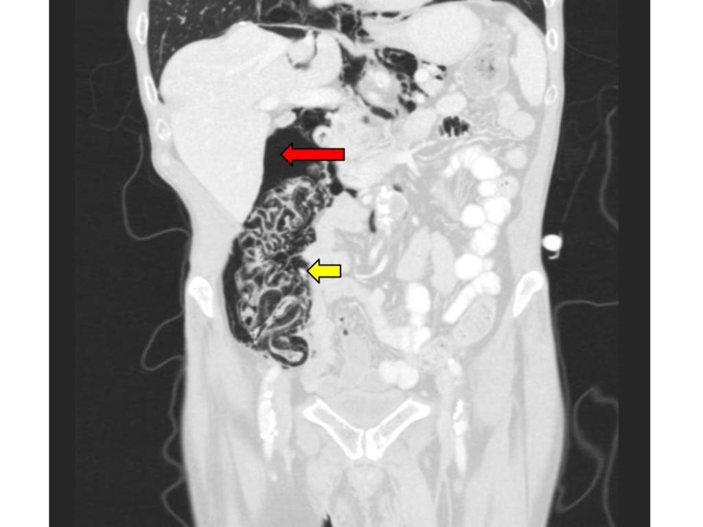 Fig. 13: Pneumatosis intestinalis of the colon complicated by free intraperitoneal air.