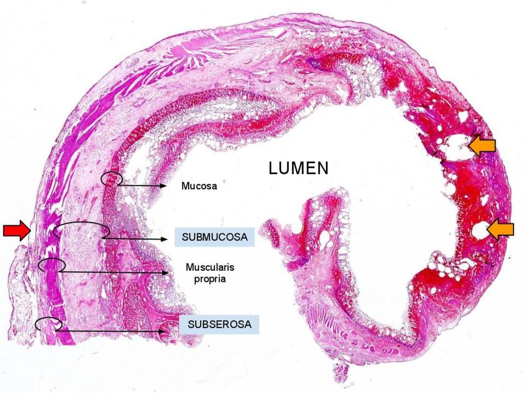 Images for this section: Fig. 1: Histology of resected bowel wall showing pneumatosis intestinalis.