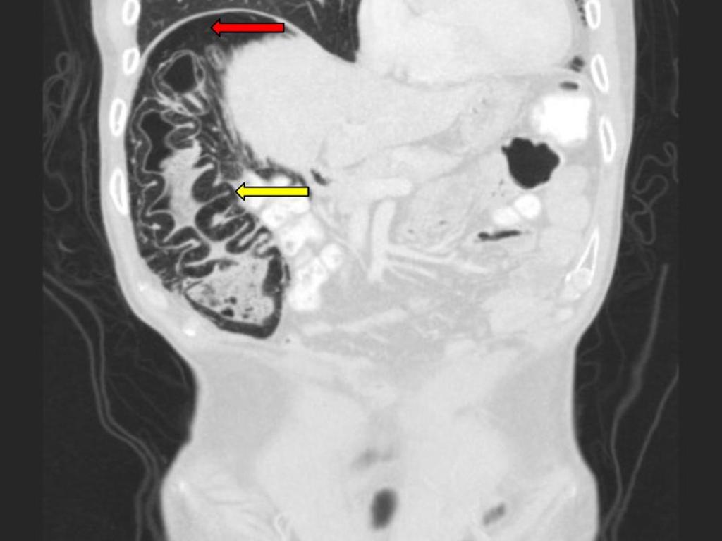 Fig. 2: CT image of pneumatosis intestinalis (yellow arrow).