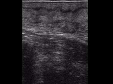 Ultrasonography Ultrasonography was done using a trans-rectal probe [linear array