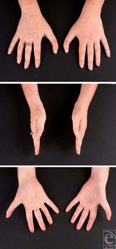 AHMAD ET AL Figure 2. Preoperative photographs of both hands depicting the bilateral triphalangism and clinodactyly of the thumbs.