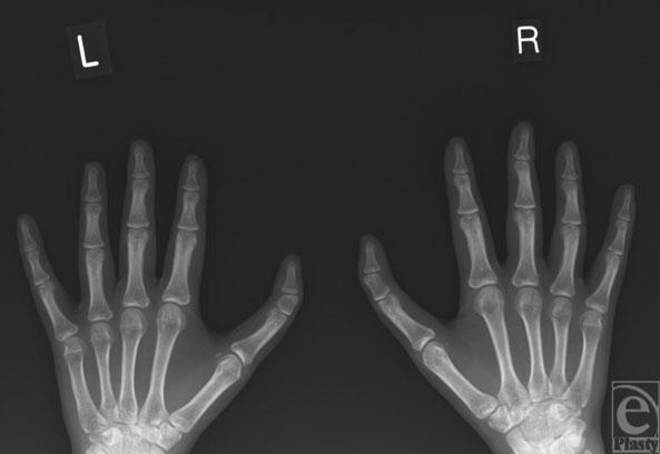 eplasty VOLUME 10 Figure 3. Preoperative radiograph of both hands showing the delta phalanx of the triphalangeal thumbs.