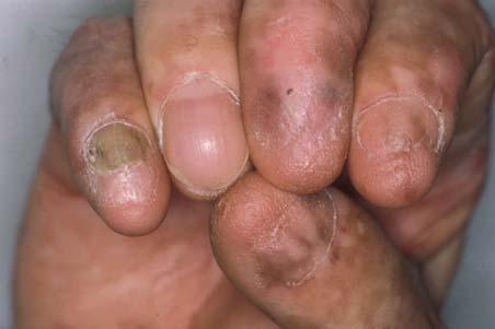 of some nail plates due to repetitive blistering. Fig. 2.