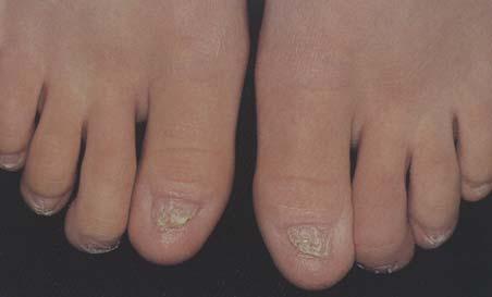 Ectodermal dysplasia, AEC type the nail plates of the