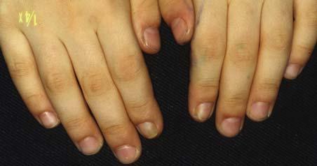 2.2 Acquired Anonychia/Micronychia 7 Iso Kikuchy Syndrome (Congenital Onychodysplasia of the Index Finger) Anonychia/micronychia/hemionychogriphosis of the index finger may be bilateral.