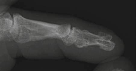 Clues for diagnosis Lateral X-ray of the digit shows Y shaped bifurcation of the distal phalanx Deformed lunula Fig. 2.13. Iso Kikuchi syndrome micronychia of the index finger.